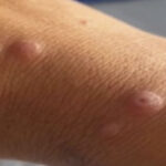 MPOX