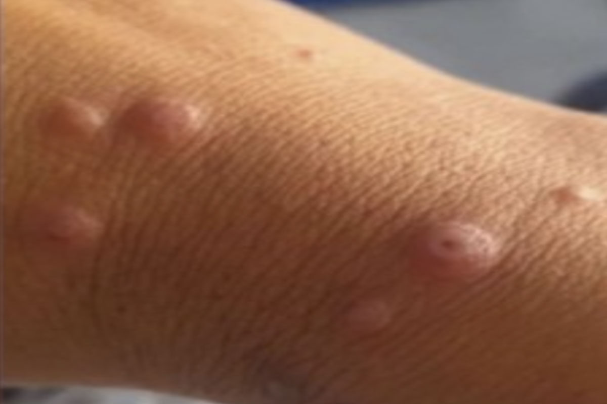 MPOX