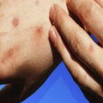 MPOX1