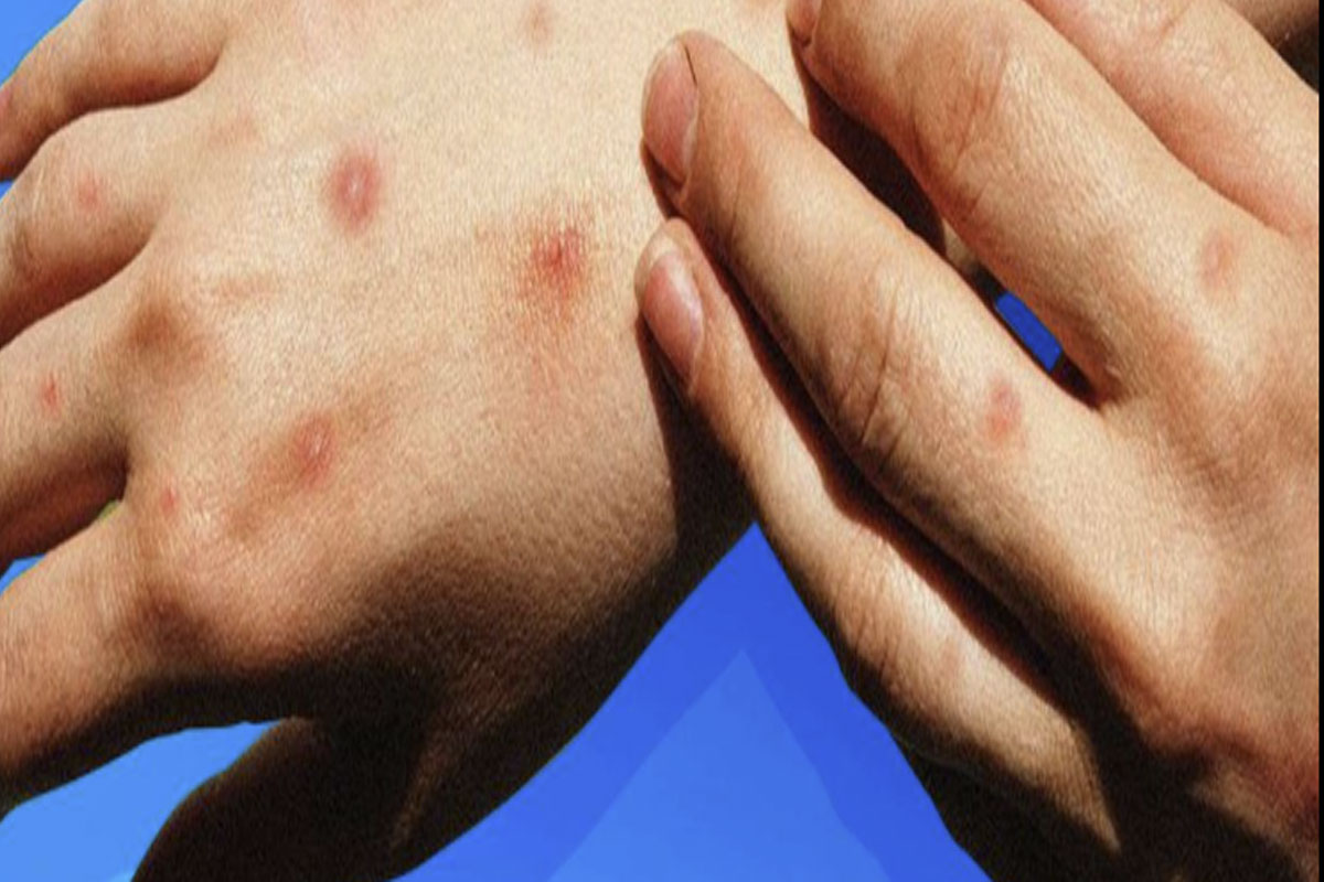 MPOX1