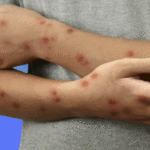 Mpox
