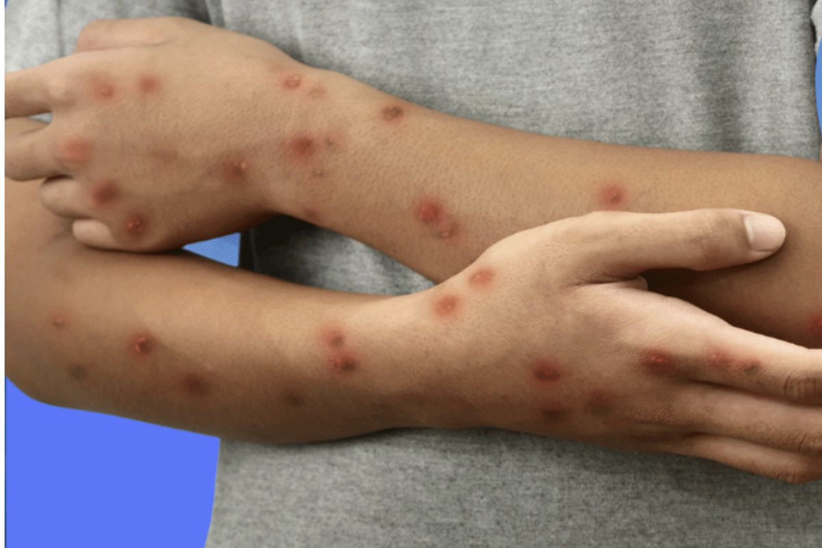 Mpox
